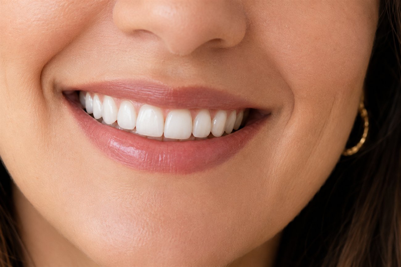 Resultado de diseño de sonrisa, aspecto natural